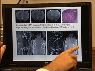 Discovery made in brain cancer research