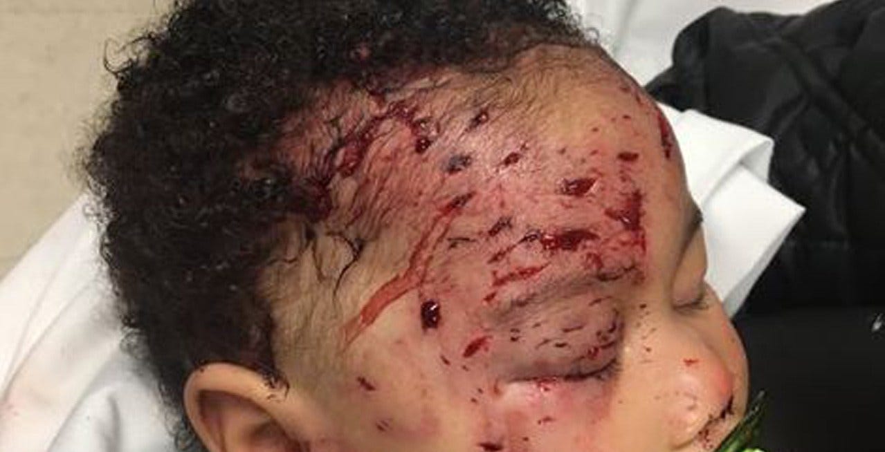 Raccoon Attacks Baby Inside Philadelphia Home, Mom Says